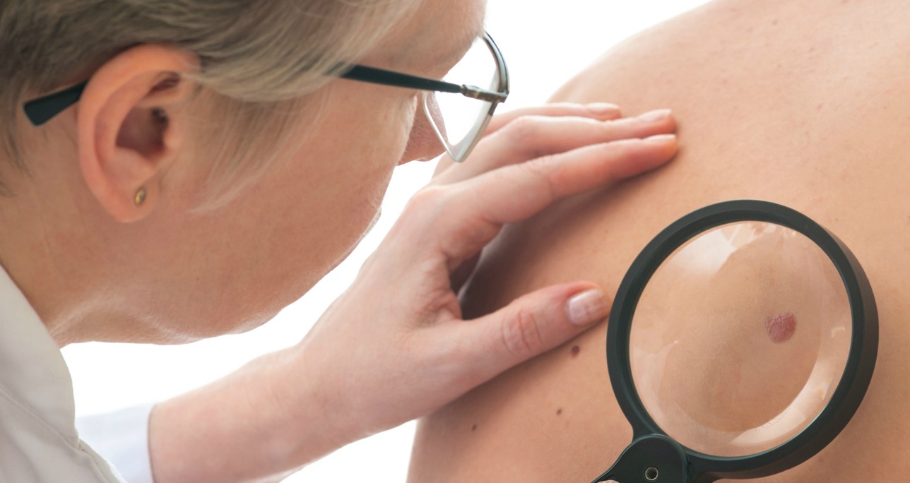 how to spot melanoma