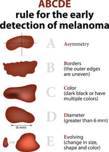 how to spot melanoma