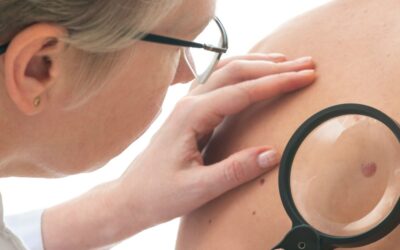 Do You Know Your ABCDEs? A Modern Guide to Skin Cancer Awareness